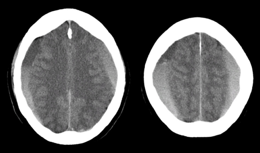 What Are Three Types Of Subdural Haematoma Karin Good Bruidstaart